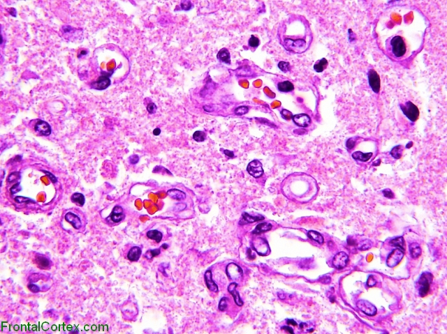 Wernicke encephalopathy Pontine Tegmentum H&E